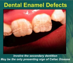 Dental Defects