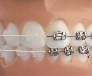 Metal Braces or Invisalign?