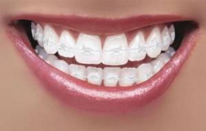 Traditional Braces