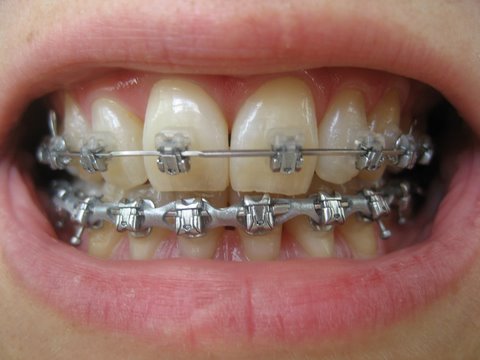 Why your Dentist Prescribes Braces