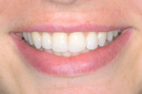 Invisalign Naperville Specialists that Straighten Teeth