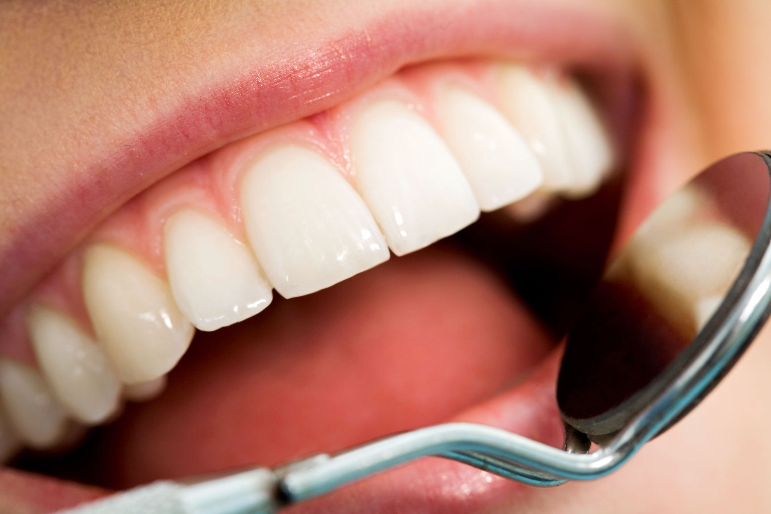 Why Choose Dentist Supervised Teeth Whitening in Wrigleyville?