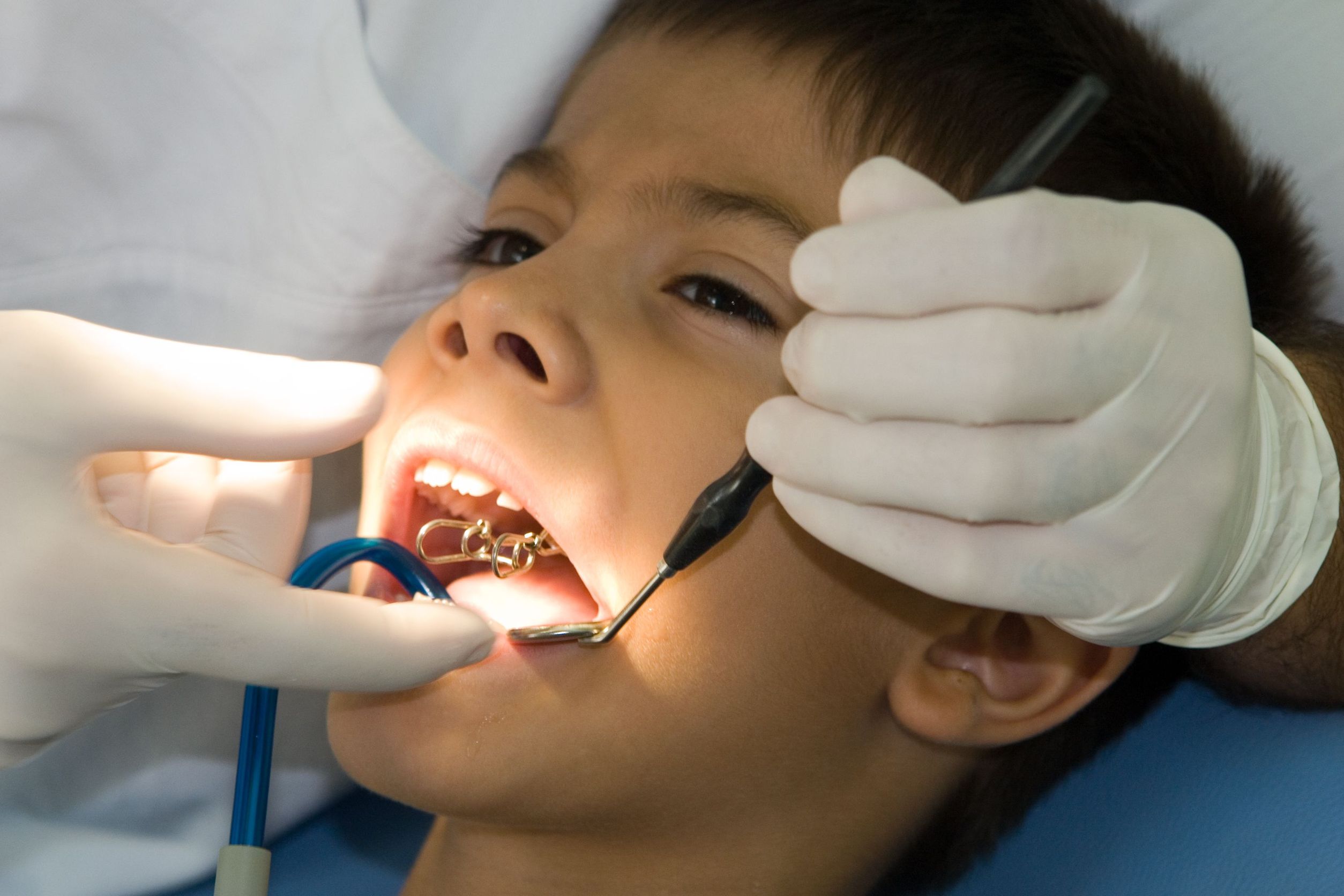 Preparing For Root Canal Treatment From Dentists In Oceanside CA