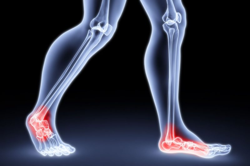 Orthotics Can Help Correct More Than Just Your Gait