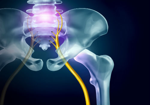 A Guide to Sciatica Pain, Symptoms, and Treatments